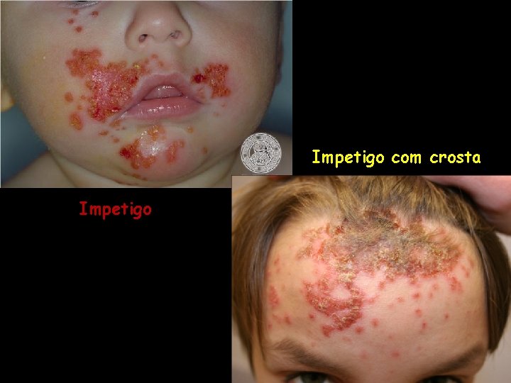 Impetigo com crosta Impetigo 