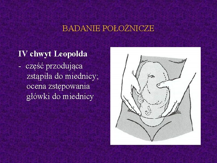 BADANIE POŁOŻNICZE IV chwyt Leopolda - część przodująca zstąpiła do miednicy; ocena zstępowania główki