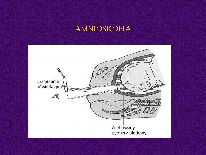 AMNIOSKOPIA 