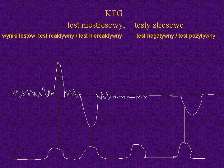  KTG test niestresowy, wyniki testów: test reaktywny / test niereaktywny testy stresowe test