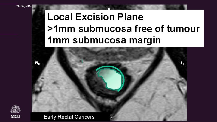 The Royal Marsden Local Excision Plane >1 mm submucosa free of tumour 1 mm