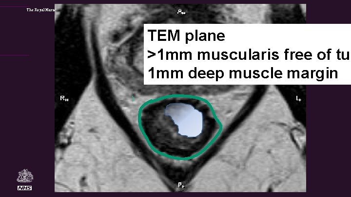 The Royal Marsden TEM plane >1 mm muscularis free of tum 1 mm deep