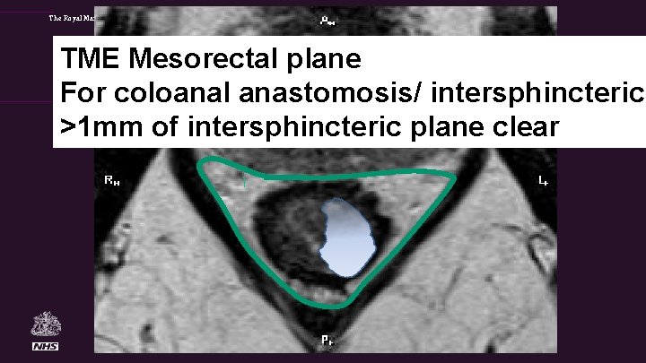 The Royal Marsden TME Mesorectal plane For coloanal anastomosis/ intersphincteric >1 mm of intersphincteric