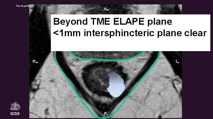 The Royal Marsden Beyond TME ELAPE plane <1 mm intersphincteric plane clear 