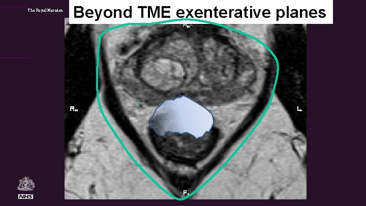 The Royal Marsden Beyond TME exenterative planes 