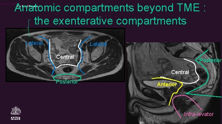 Anatomic compartments beyond TME : the exenterative compartments The Royal Marsden Lateral Central Posterior