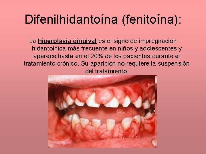 Difenilhidantoína (fenitoína): La hiperplasia gingival es el signo de impregnación hidantoínica más frecuente en
