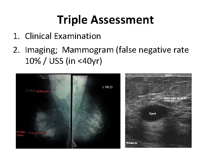 Triple Assessment 1. Clinical Examination 2. Imaging; Mammogram (false negative rate 10% / USS