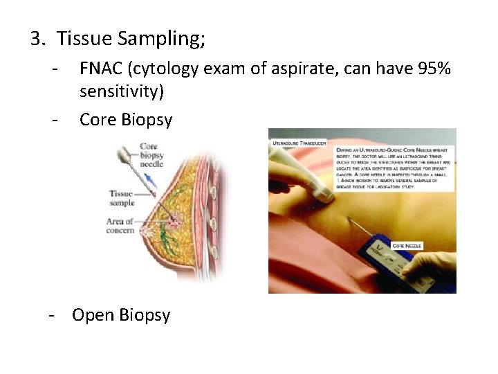 3. Tissue Sampling; - FNAC (cytology exam of aspirate, can have 95% sensitivity) Core