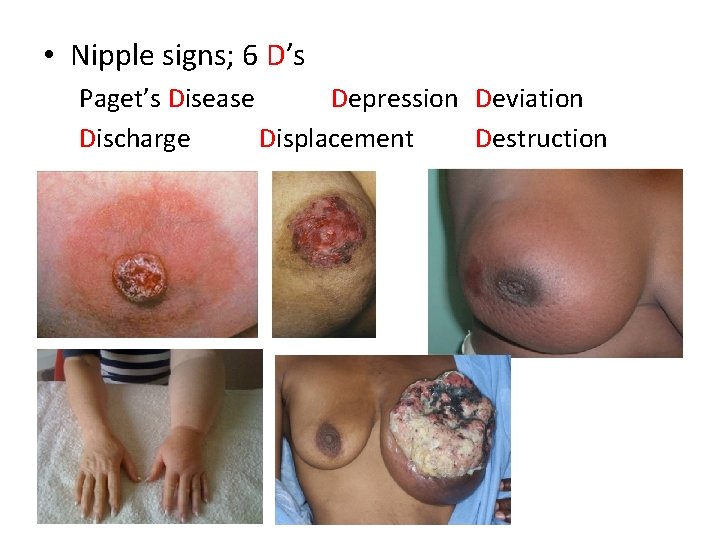  • Nipple signs; 6 D’s Paget’s Disease Depression Deviation Discharge Displacement Destruction 