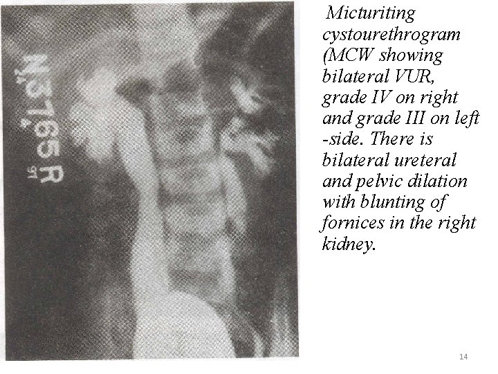 Micturiting cystourethrogram (MCW showing bilateral VUR, grade IV on right and grade III on Micturiting cystourethrogram (MCW showing bilateral VUR, grade IV on right and grade III on
