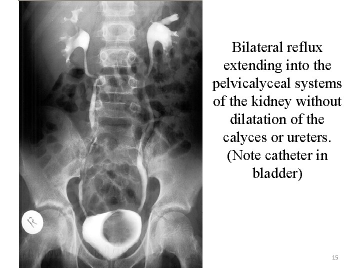 Bilateral reflux extending into the pelvicalyceal systems of the kidney without dilatation of the Bilateral reflux extending into the pelvicalyceal systems of the kidney without dilatation of the