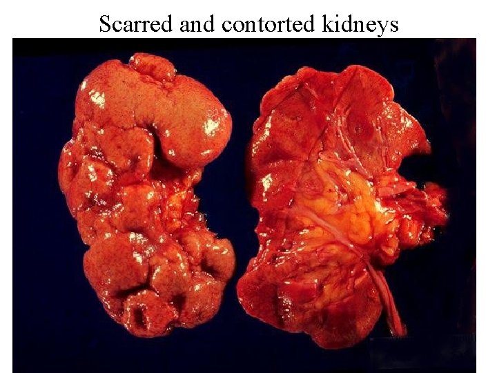 Scarred and contorted kidneys 23 Scarred and contorted kidneys 23
