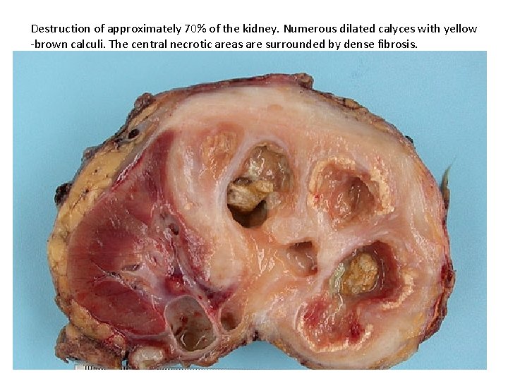 Destruction of approximately 70% of the kidney. Numerous dilated calyces with yellow -brown calculi. Destruction of approximately 70% of the kidney. Numerous dilated calyces with yellow -brown calculi.