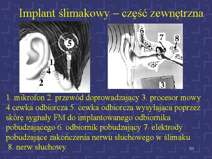 Implant ślimakowy – część zewnętrzna 1. mikrofon 2. przewód doprowadzający 3. procesor mowy 4