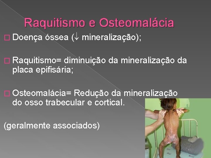 Raquitismo e Osteomalácia � Doença óssea ( mineralização); � Raquitismo= diminuição da mineralização da