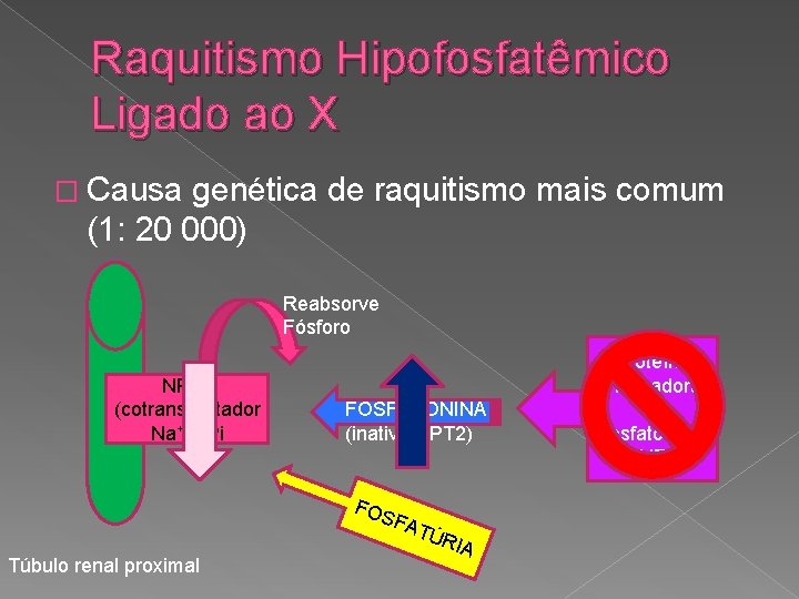 Raquitismo Hipofosfatêmico Ligado ao X � Causa genética de raquitismo mais comum (1: 20