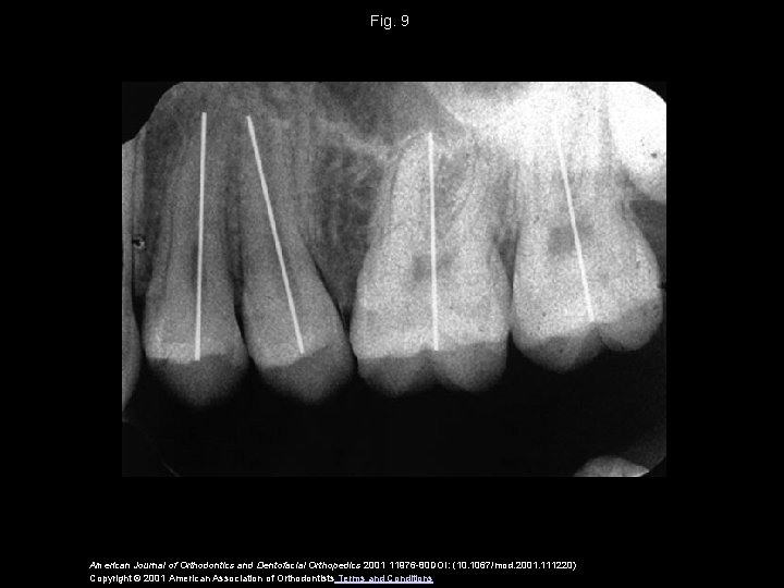 Fig. 9 American Journal of Orthodontics and Dentofacial Orthopedics 2001 11976 -80 DOI: (10.