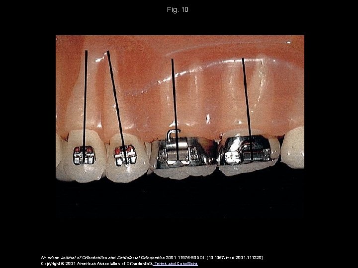 Fig. 10 American Journal of Orthodontics and Dentofacial Orthopedics 2001 11976 -80 DOI: (10.