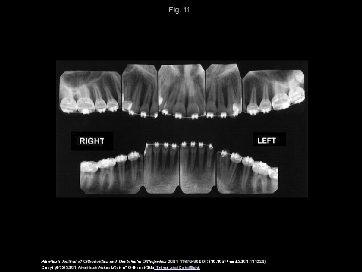 Fig. 11 American Journal of Orthodontics and Dentofacial Orthopedics 2001 11976 -80 DOI: (10.