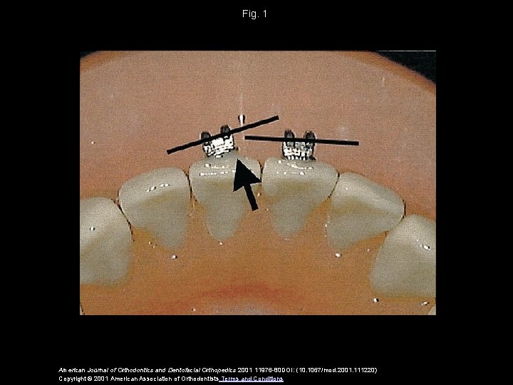 Fig. 1 American Journal of Orthodontics and Dentofacial Orthopedics 2001 11976 -80 DOI: (10.