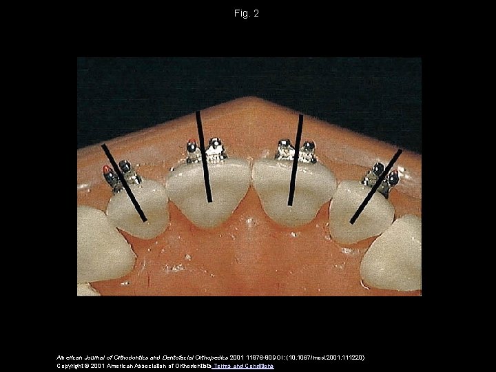 Fig. 2 American Journal of Orthodontics and Dentofacial Orthopedics 2001 11976 -80 DOI: (10.