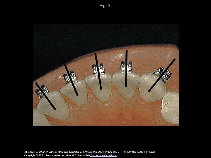 Fig. 3 American Journal of Orthodontics and Dentofacial Orthopedics 2001 11976 -80 DOI: (10.