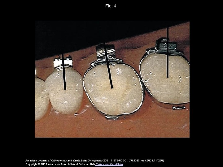 Fig. 4 American Journal of Orthodontics and Dentofacial Orthopedics 2001 11976 -80 DOI: (10.