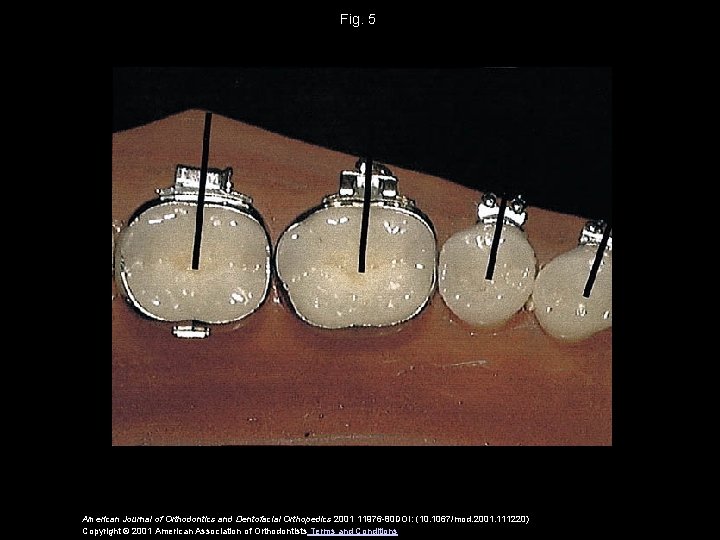 Fig. 5 American Journal of Orthodontics and Dentofacial Orthopedics 2001 11976 -80 DOI: (10.