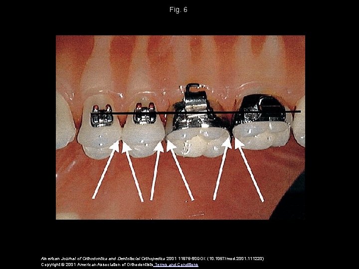 Fig. 6 American Journal of Orthodontics and Dentofacial Orthopedics 2001 11976 -80 DOI: (10.