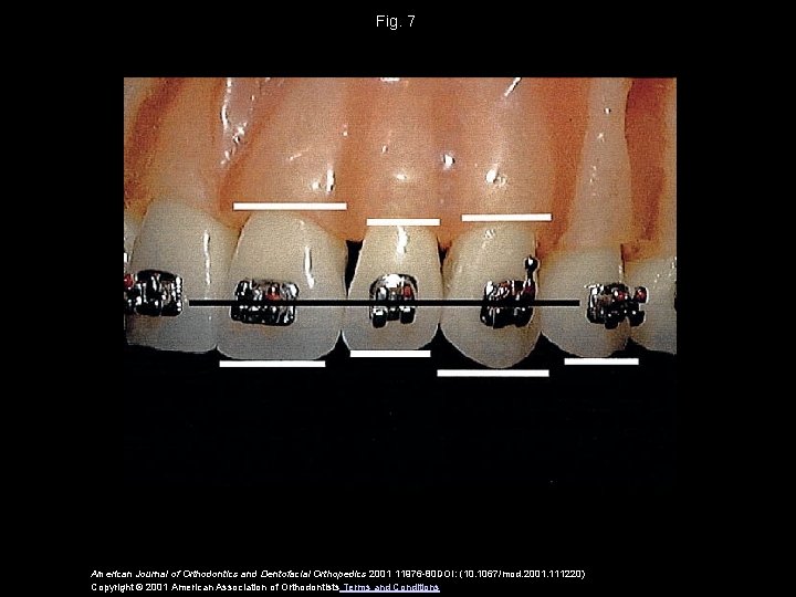 Fig. 7 American Journal of Orthodontics and Dentofacial Orthopedics 2001 11976 -80 DOI: (10.