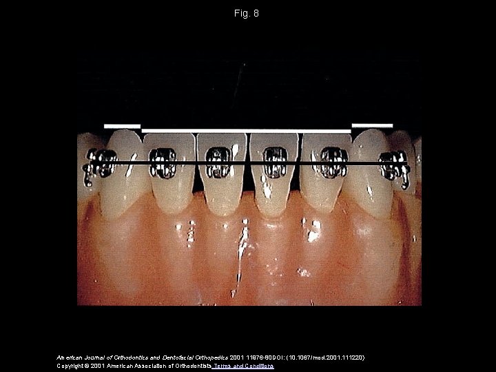 Fig. 8 American Journal of Orthodontics and Dentofacial Orthopedics 2001 11976 -80 DOI: (10.