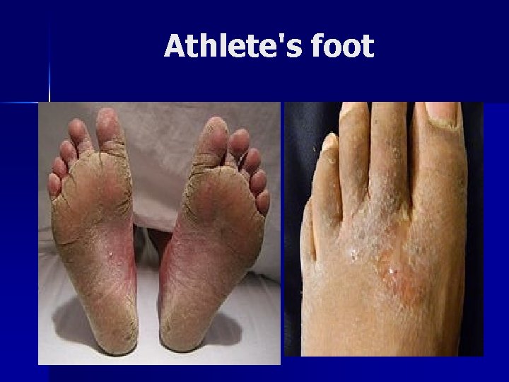 Athlete's foot 