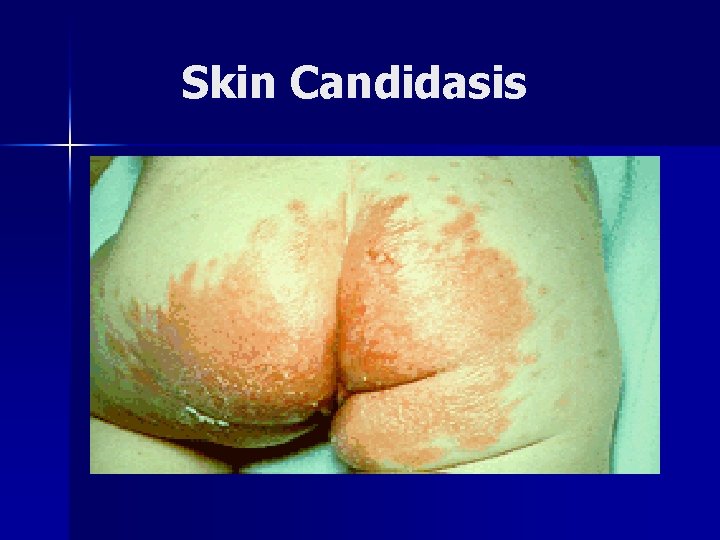 Skin Candidasis 