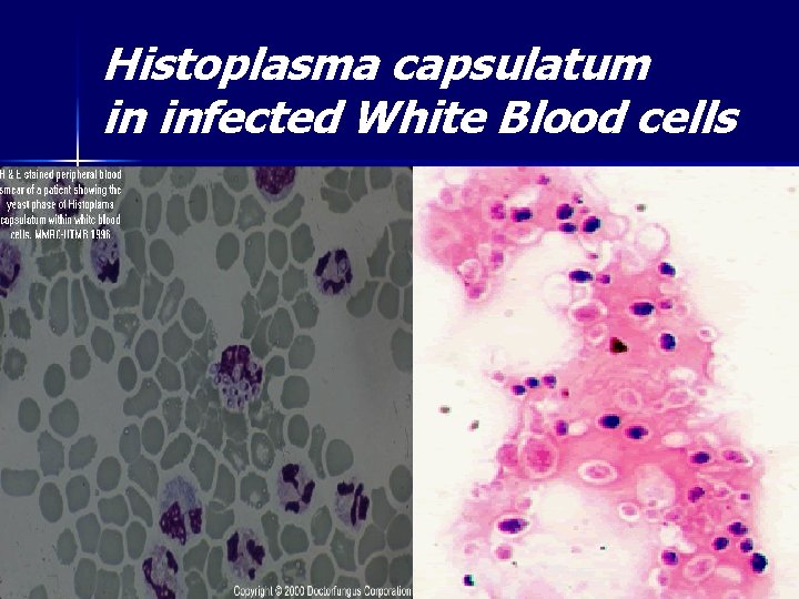 Histoplasma capsulatum in infected White Blood cells 