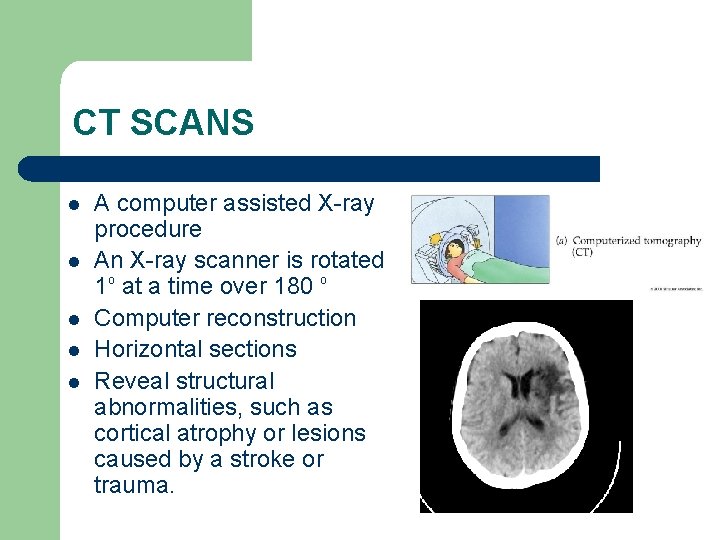 CT SCANS l l l A computer assisted X-ray procedure An X-ray scanner is