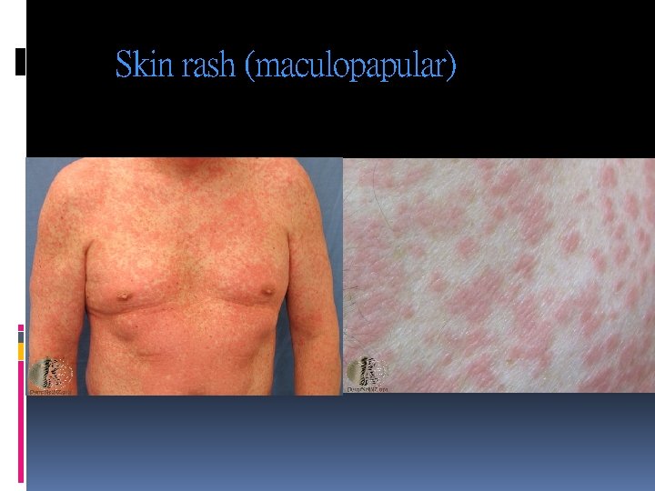 Skin rash (maculopapular) 