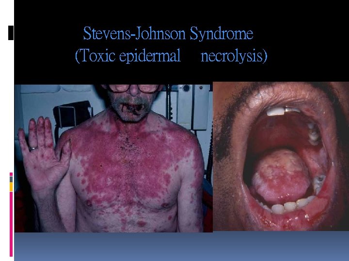 Stevens-Johnson Syndrome (Toxic epidermal necrolysis) 