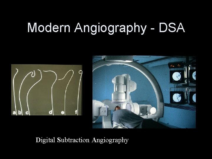 Modern Angiography - DSA Digital Subtraction Angiography 