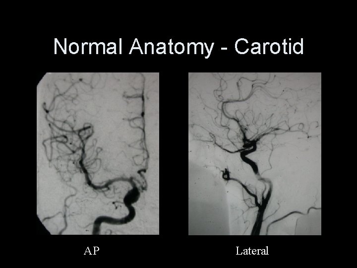 Normal Anatomy - Carotid AP Lateral 
