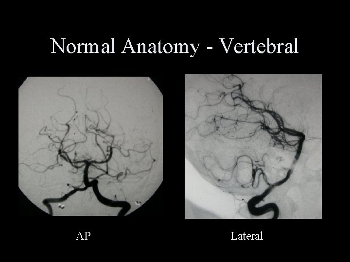Normal Anatomy - Vertebral AP Lateral 