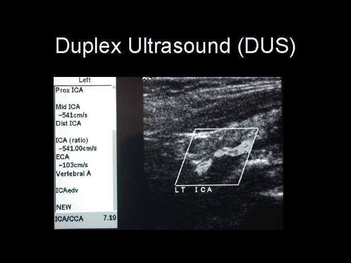 Duplex Ultrasound (DUS) 