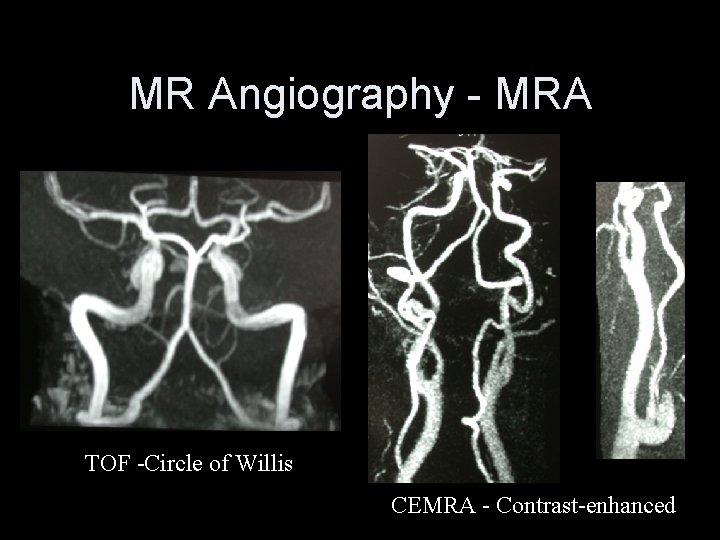 MR Angiography - MRA TOF -Circle of Willis CEMRA - Contrast-enhanced 
