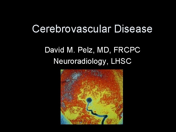 Cerebrovascular Disease David M. Pelz, MD, FRCPC Neuroradiology, LHSC 