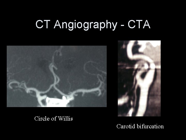 CT Angiography - CTA Circle of Willis Carotid bifurcation 