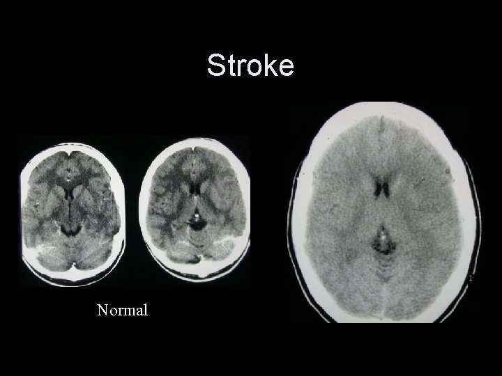 Stroke Normal 