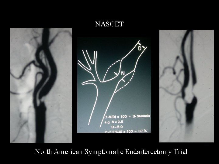 NASCET North American Symptomatic Endarterectomy Trial 
