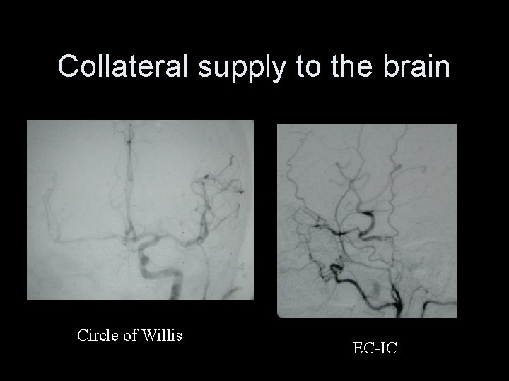 Collateral supply to the brain Circle of Willis EC-IC 