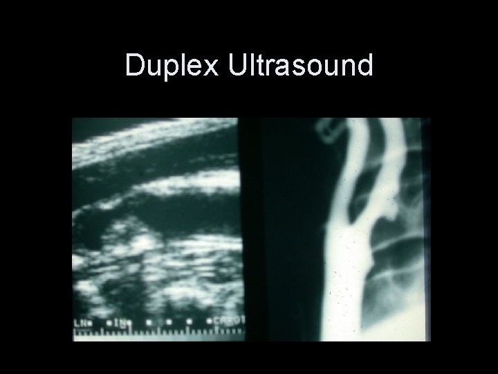 Duplex Ultrasound 