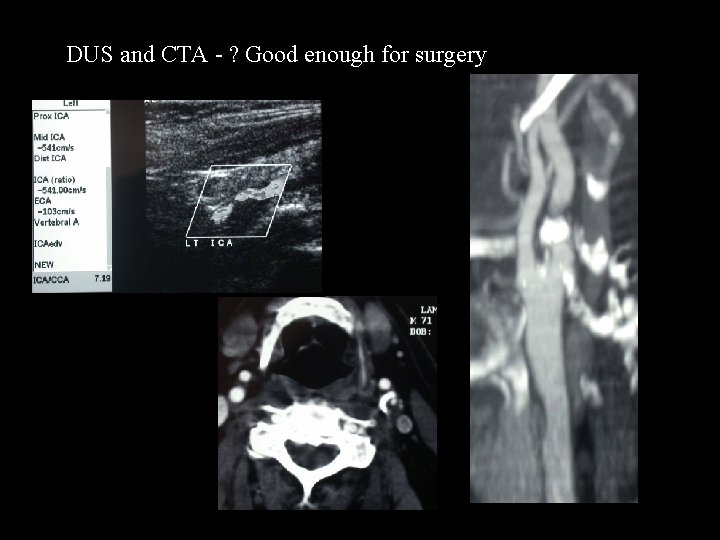 DUS and CTA - ? Good enough for surgery 